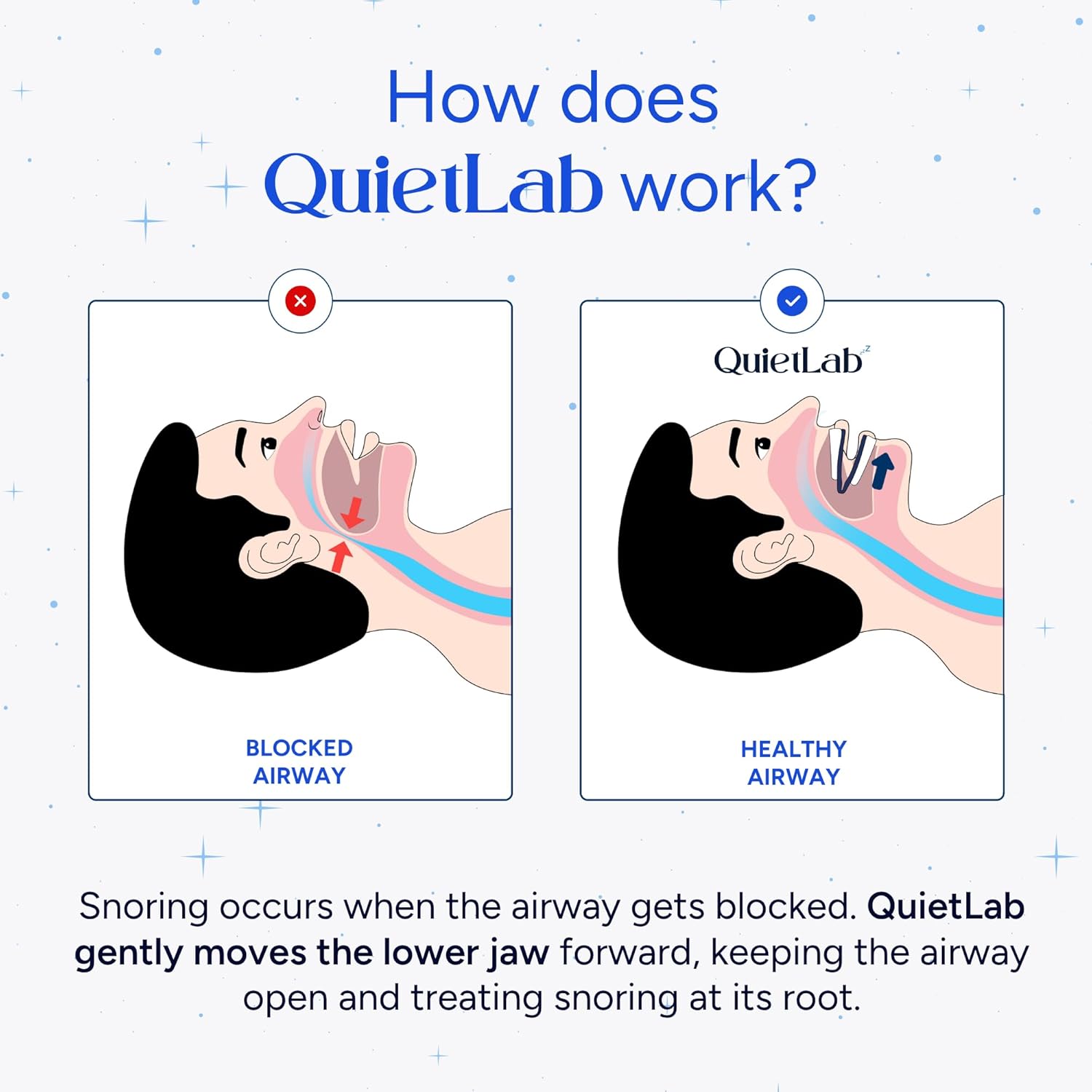 Adjustable Anti-Snoring Mouthpiece